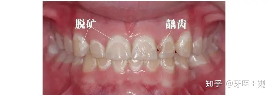 快看,牙齿脱矿咋变这样了?还有挽救办法吗?