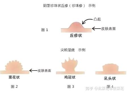 gui头冠状沟处长了小疙瘩是xing病吗?下面,就给大家一一科普一下.