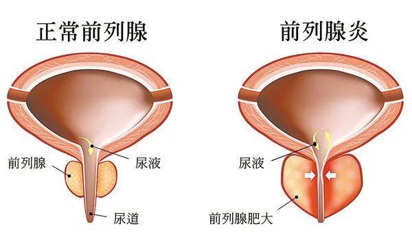 前列腺炎真实图片部位图片