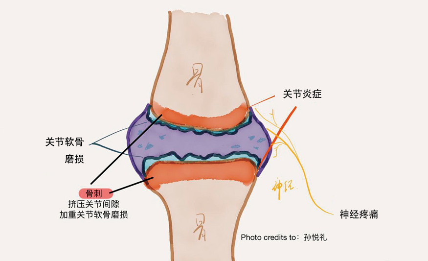 你对骨刺到底了解多少?真相太令人意外了