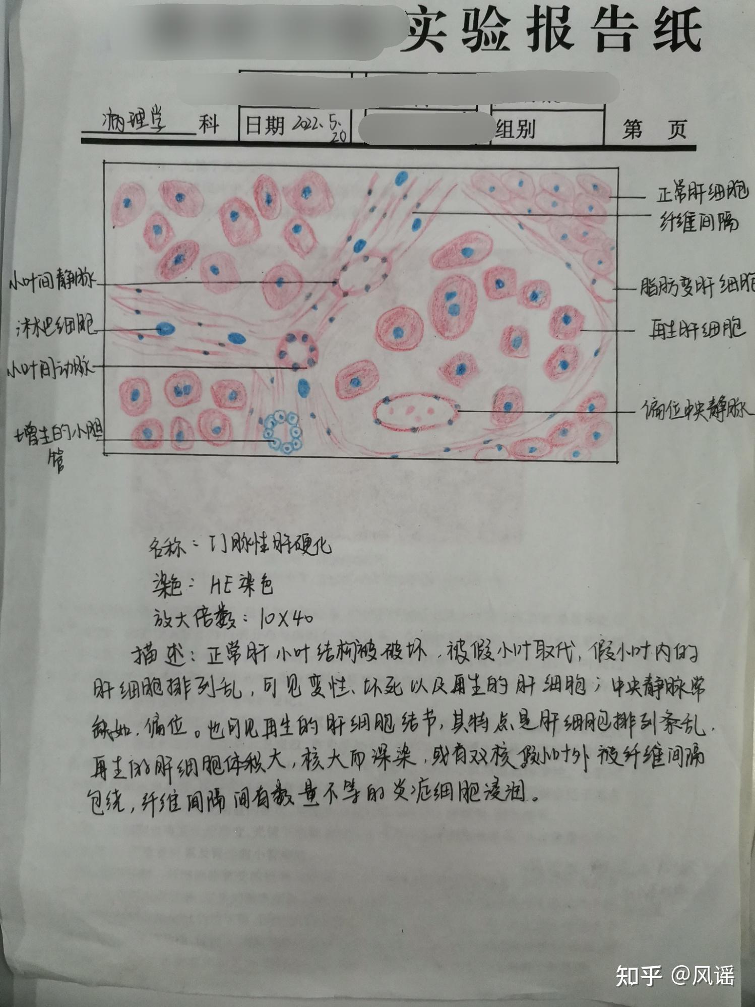 4.門脈性肝硬化3.風溼性心肌炎2.鱗狀細胞癌1.