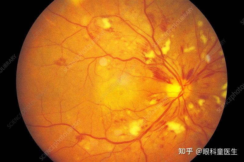 与系统性疾病相关的视网膜病变——1,高血压动脉硬化性眼底改变改变