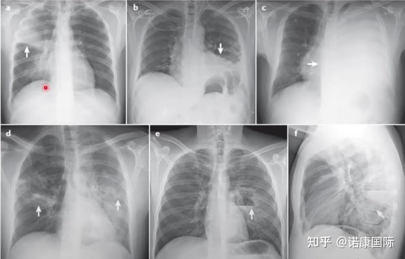 癌症患者怎样安全度过疫情,警惕出现"白肺"现象 - 知乎