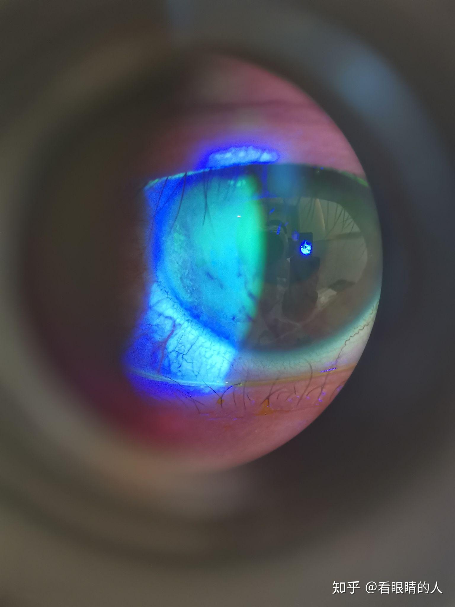 这是我用手拿着手机对着裂隙灯目镜拍下的各种眼部病变的照
