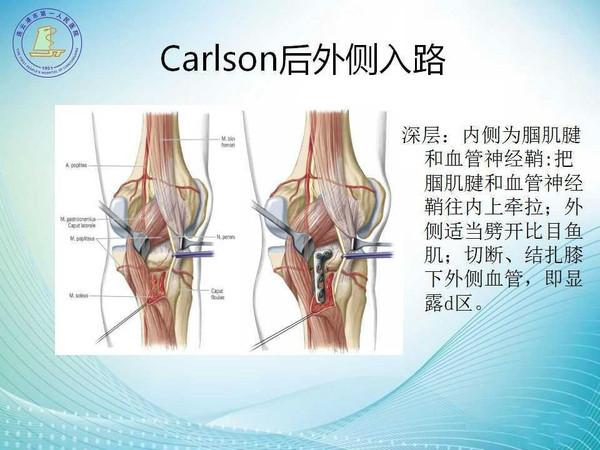 胫骨后倾角图片