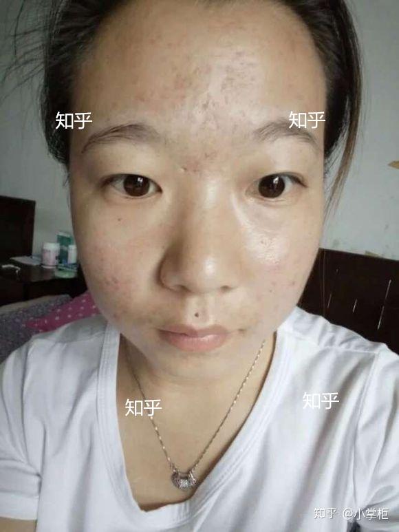 为什么会长闭口粉刺?怎么消灭闭口粉刺?