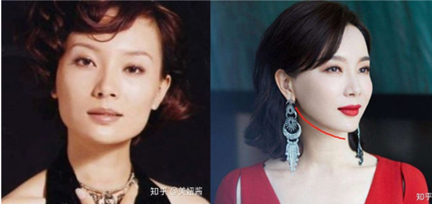 下颌角削骨对人的改变有多大 削骨有什么后遗症吗 知乎