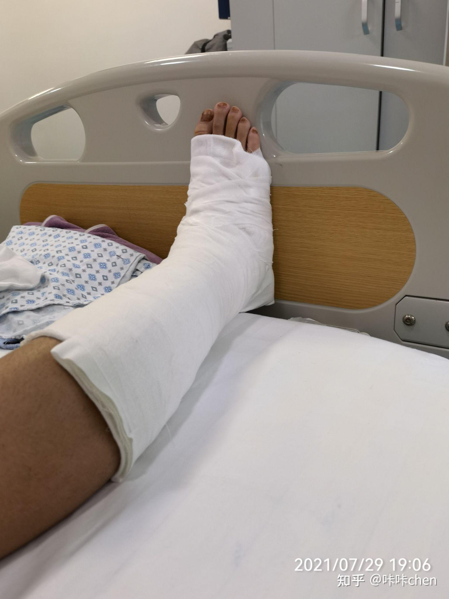 踝关节距骨软骨微骨折与韧带修复手术,及康复历程 
