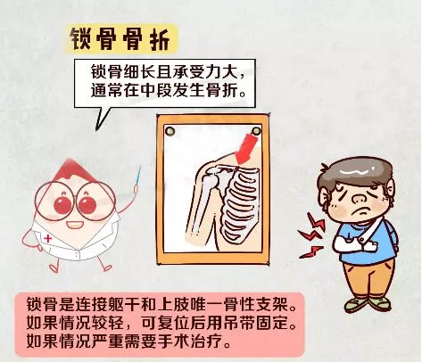 锁骨骨折要不要做手术