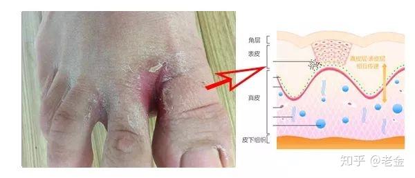 科普 足部皮肤最大的危害 脚气 知乎