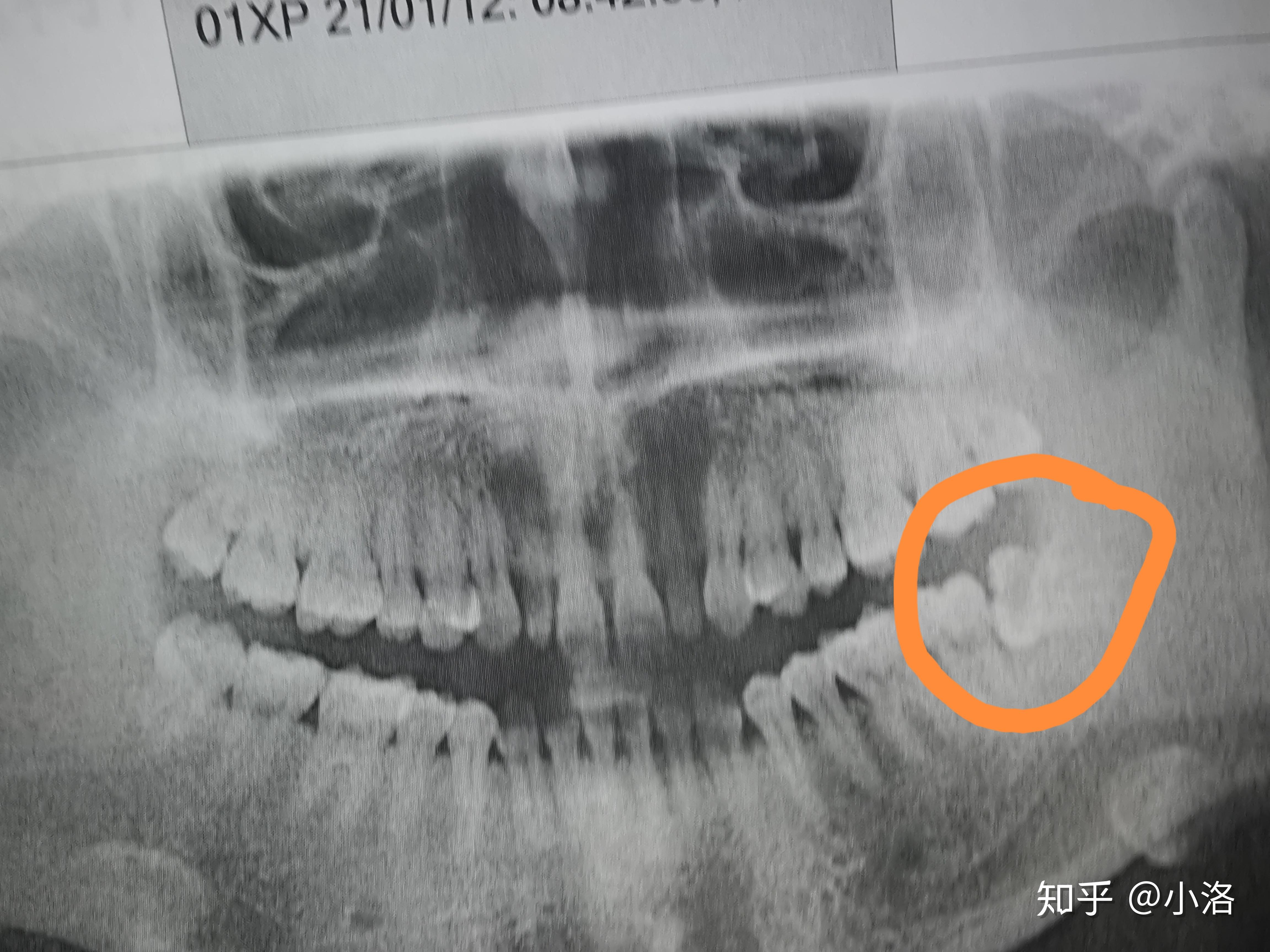 就是不太明白为什么会说是完全性骨埋伏阻生牙,不该是半埋伏吗?