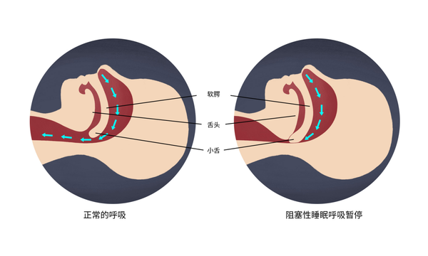 打呼噜≠睡得香,对神经系统有哪些危害? - 知乎