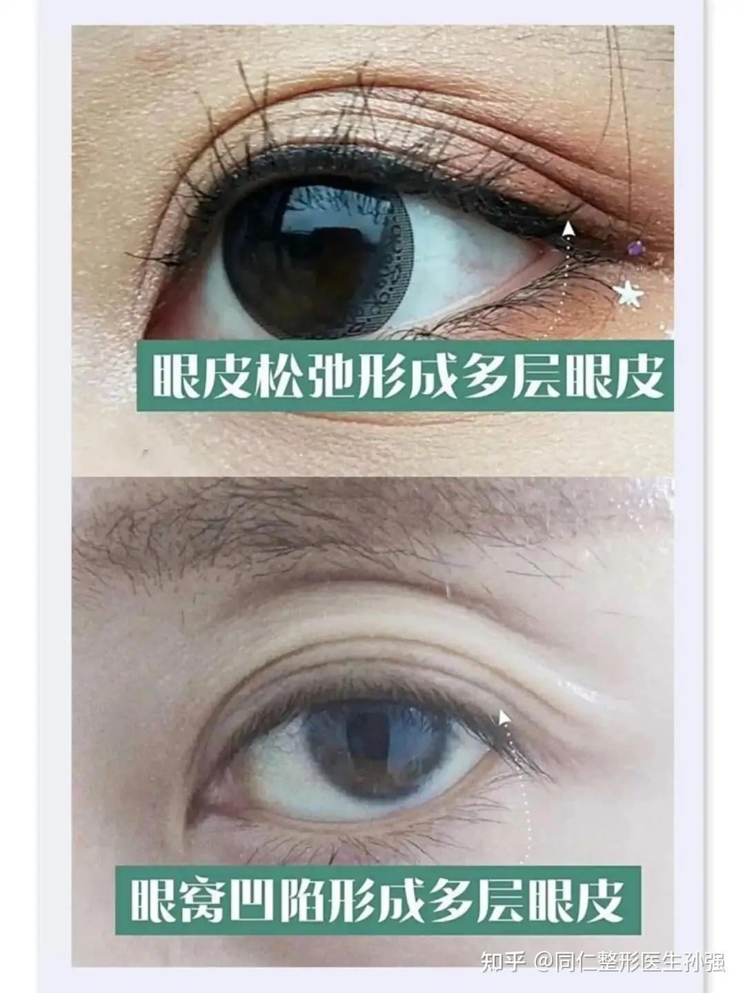 北京双眼皮科普怎么让多层眼皮变成双眼皮