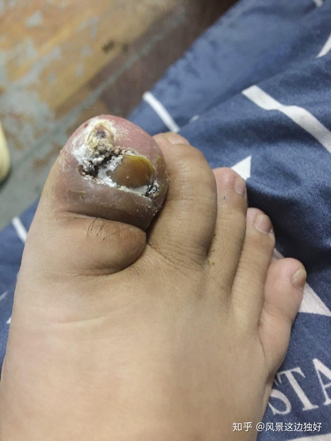 甲沟炎趾甲剪太短有肉芽不手术还能治好吗