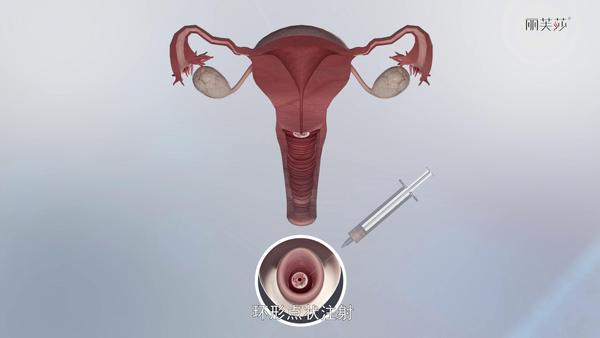 图丨宫颈注射