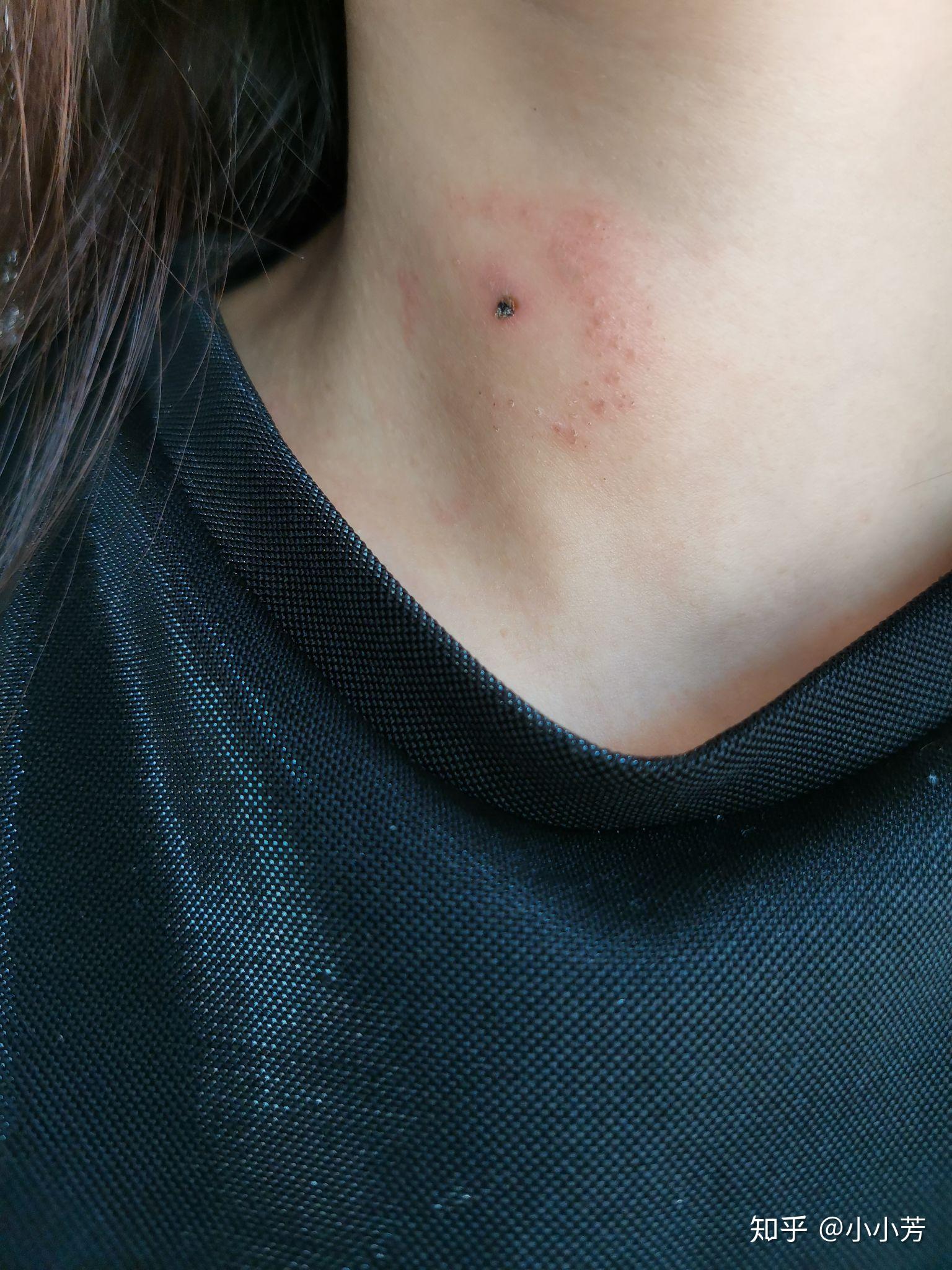 白醋祛除丝状疣