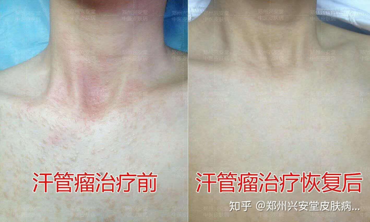 汗管瘤的危害有哪些