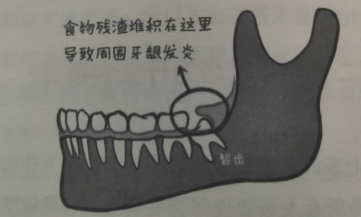 当还没有完全长出来的时候,一部分牙龈覆盖在智齿上,形成了盲袋这个