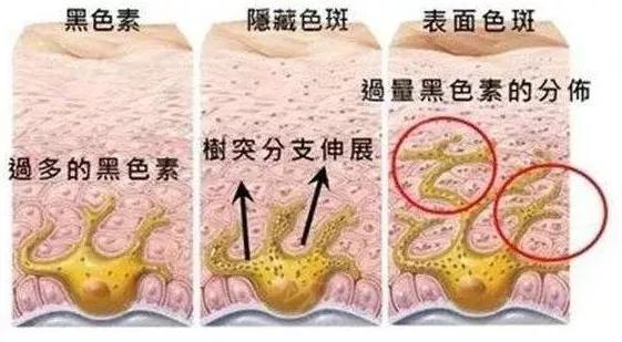 怎样祛斑最快最有效有什么效果好的土方法祛斑不反弹