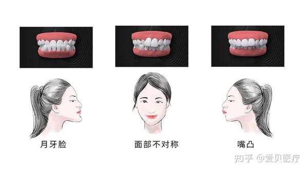 正颌那些事儿Ⅰ:关于“牙颌面畸形”,你知道多少? - 知乎
