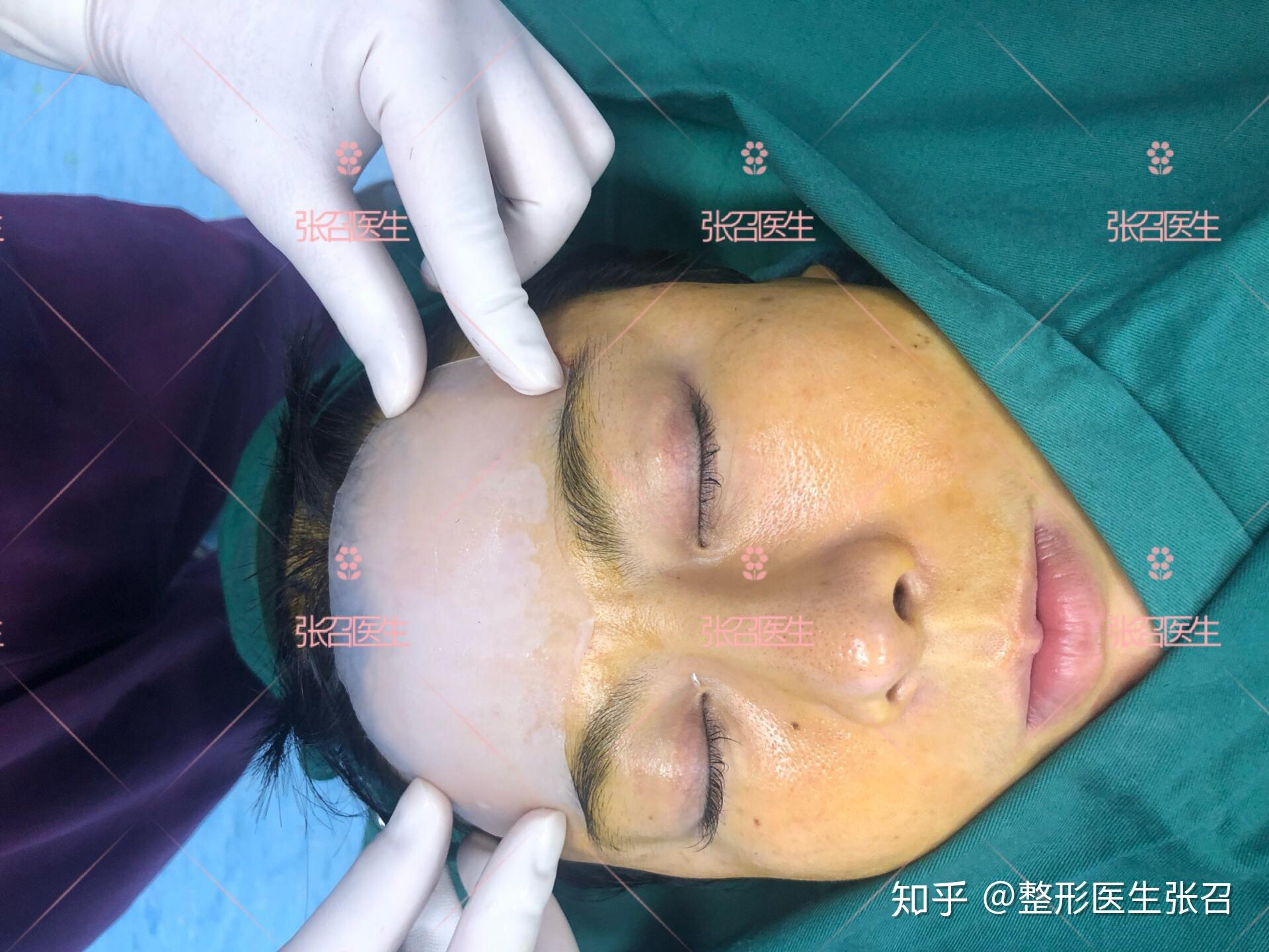 假体能丰额头吗?