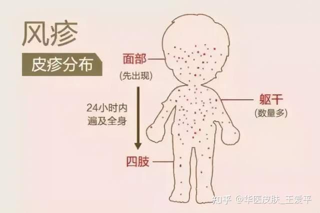 风疹和风团疙瘩二者的区别,风团疙瘩有哪些治疗方法? - 知乎