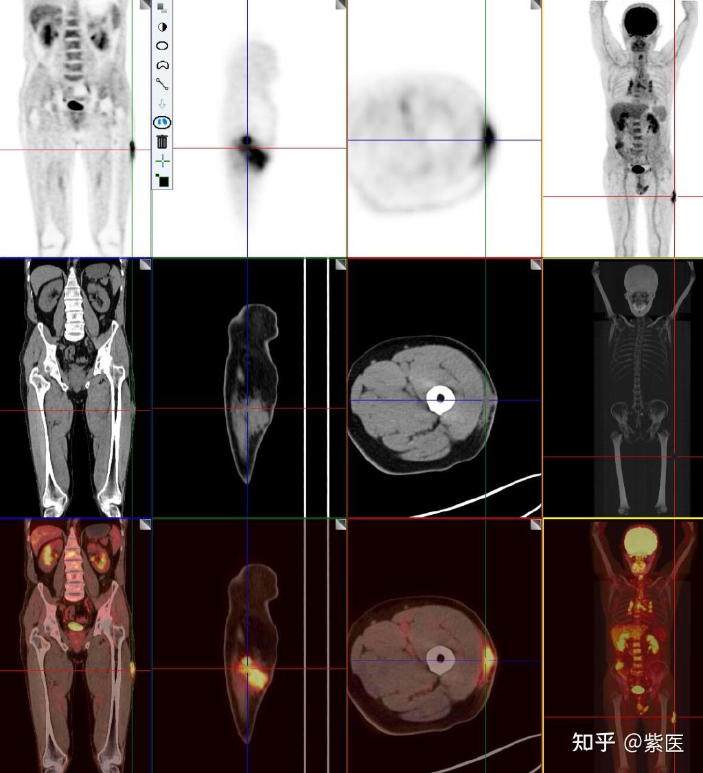 老年男性左大腿包块，18F-FDG PET/CT诊断肉瘤 - 知乎