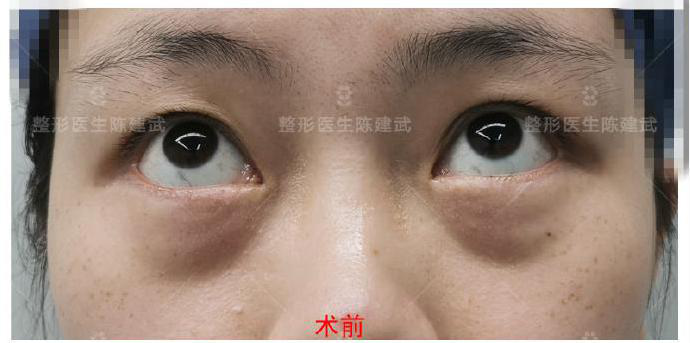 做完眼袋手术消肿后还有眼袋 算不算手术失败 知乎 做完眼袋手术消肿后还有眼袋 算不算手术失败 知乎