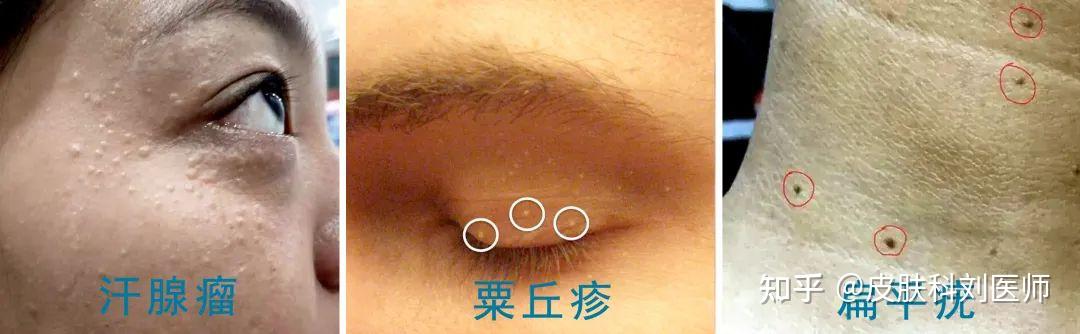 扁平疣如何自查?攻略来啦! - 知乎