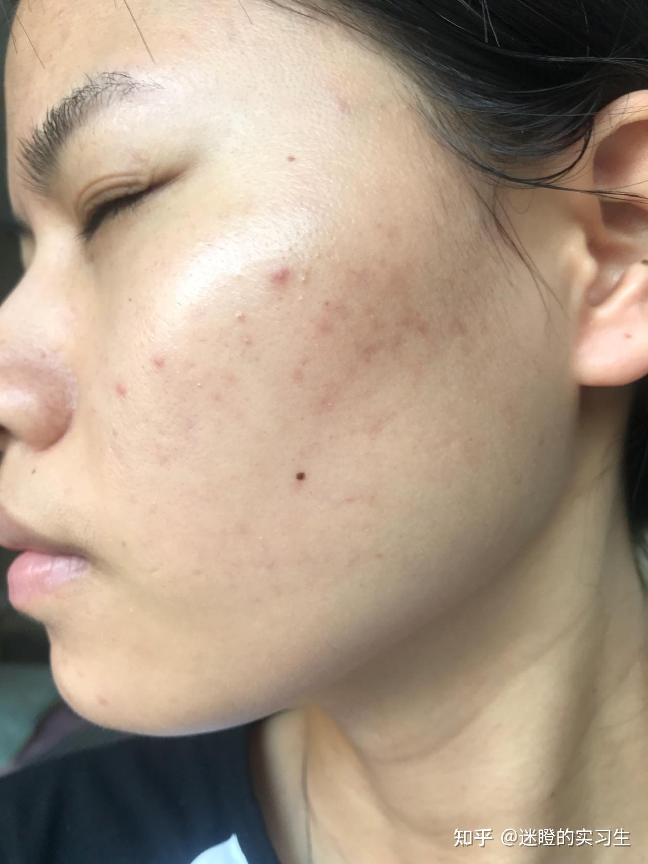 刷酸祛痘效果怎么样有用吗