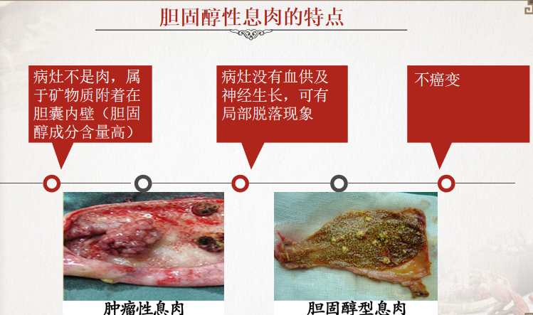 胆囊息肉严重吗图片