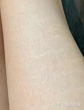 淡化肥胖纹跟所有身体油都没关系,再贵再便宜也别瞎买!真正能淡