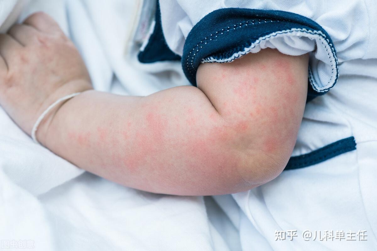幼儿急疹、麻疹、川崎病、水痘、风疹，如何识别不同皮疹？_湃客_澎湃新闻-The Paper