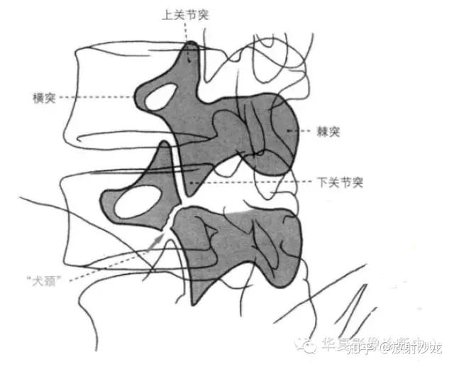 基础解剖图 实实在在明白腰椎椎弓峡部裂与椎体滑脱