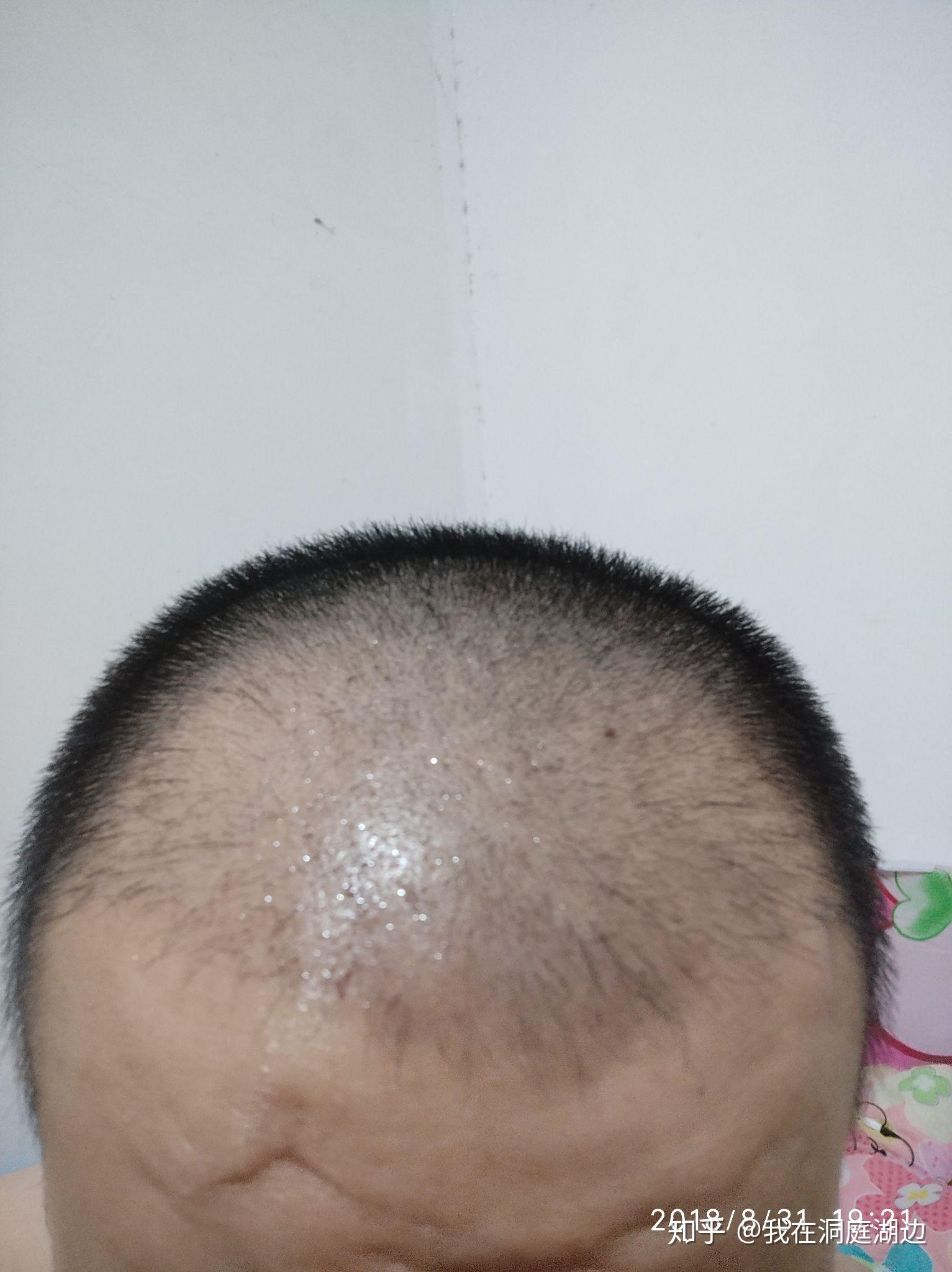 艾斯植发(植发的坏处和后遗症)