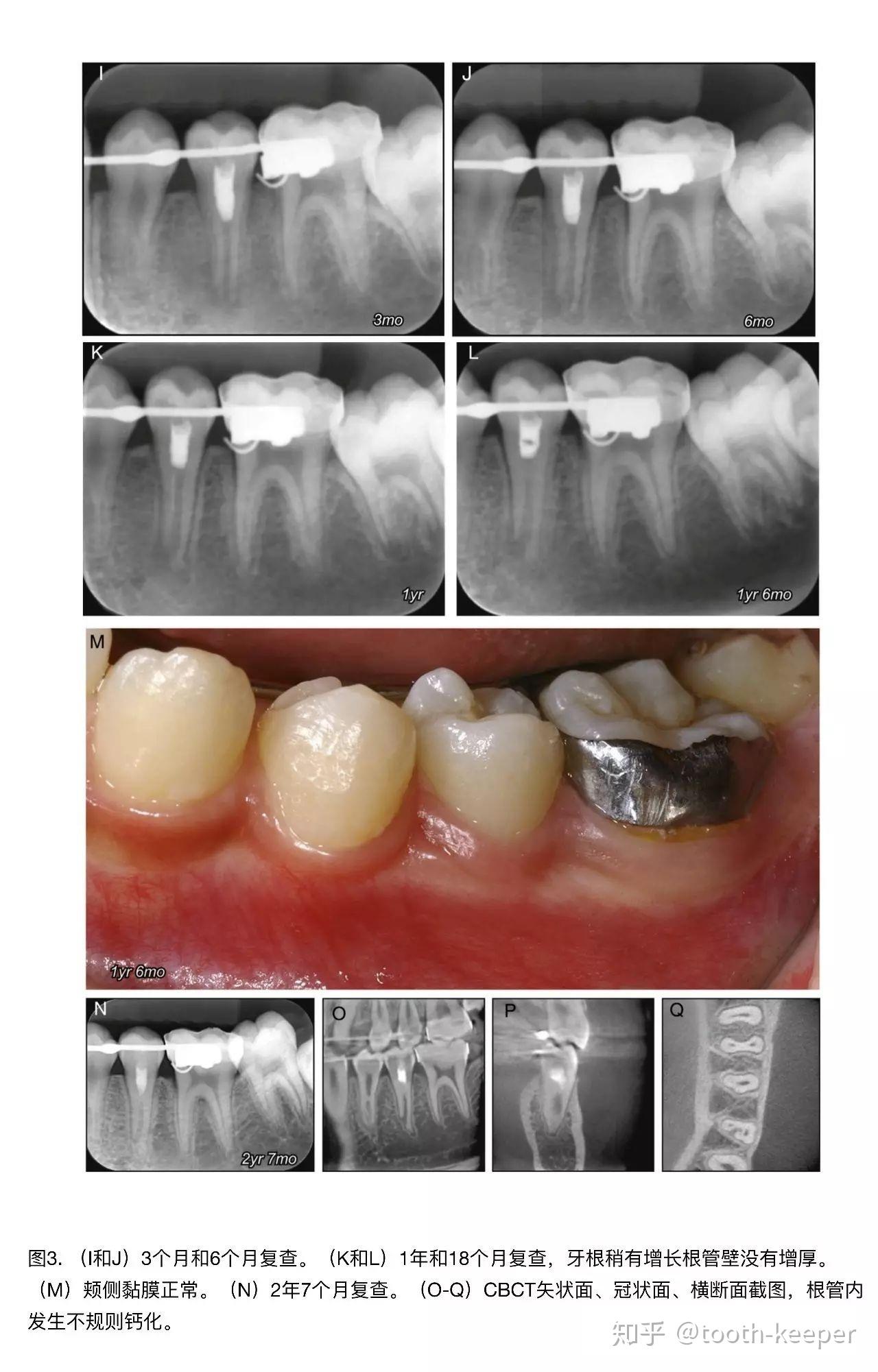 口腔口变色牙与牙裂牙及牙髓坏死 编辑类照片. 图片 包括有 堵嘴, 患者, 疾病, 医学, 褪色, 牙科 - 180502086