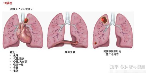 肺癌的真正的分期和治疗 看懂这些知识 再也不花一分冤枉钱 知乎 肺癌的真正的分期和治疗 看懂这些知识 再也不花一分冤枉钱 知乎