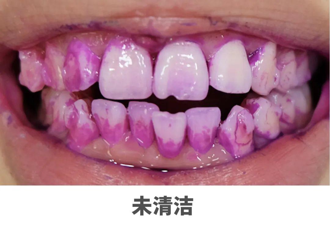 巴氏刷牙法我掌握得不太熟练,但能很明显地看出牙齿表面的牙菌斑都被
