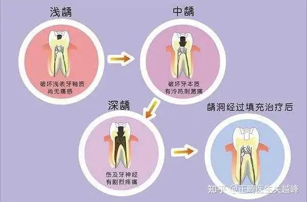 牙齿龋坏到什么程度,才需要做根管治疗? - 知乎