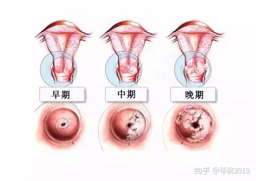 hpv感染后离宫颈癌还有多远