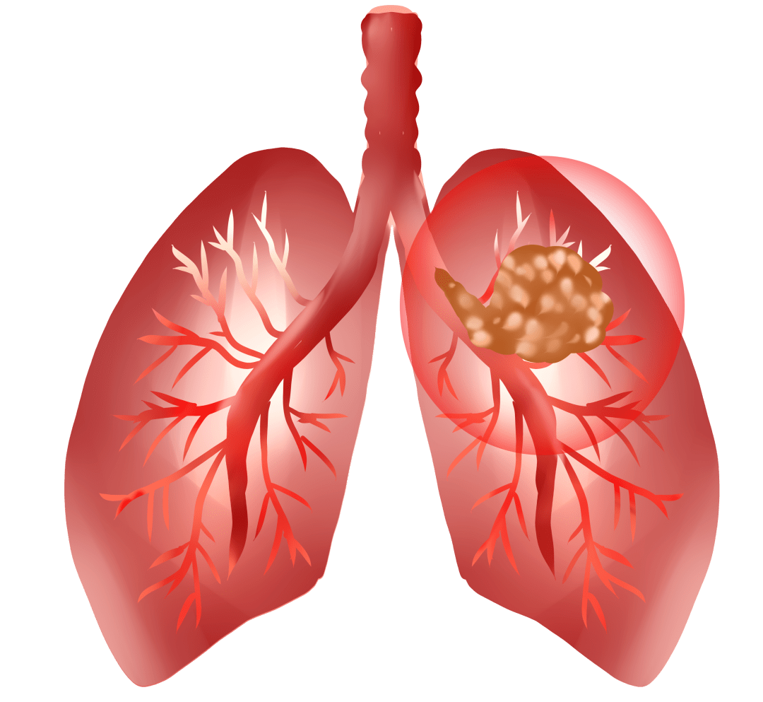肺癌的早期症状和前兆有哪些？肺癌早期筛查项目_中康体检网