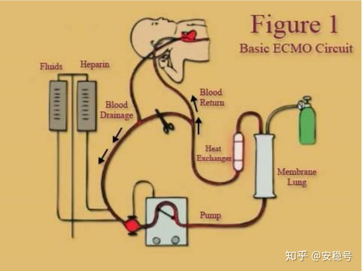ECMO的救护车安装方案 - 知乎