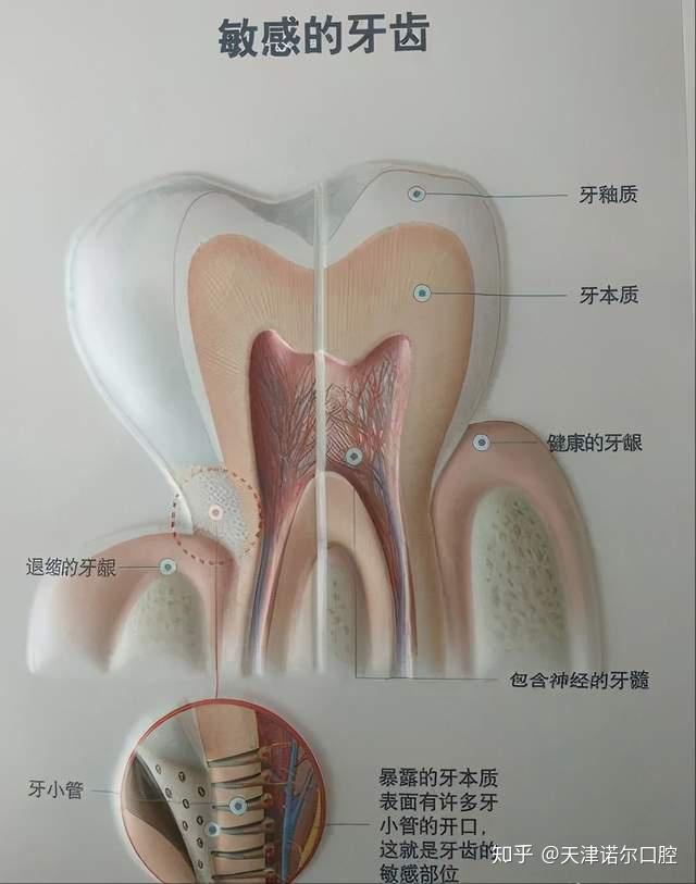 洗牙就100左右医生不赚钱为什么老推荐你洗牙呢