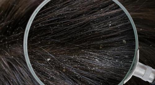 如何去除头发上的,有什么方法?