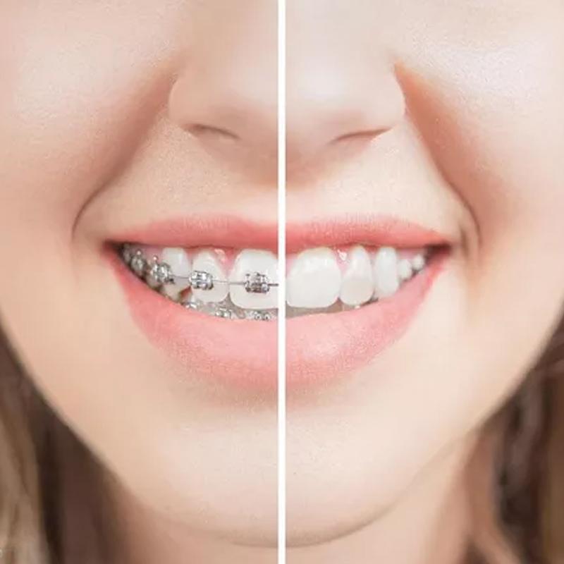 传统矫正隐形矫正哪个效果更好