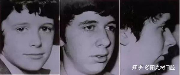 口呼吸为什么会让人变丑 如何变美回来 知乎