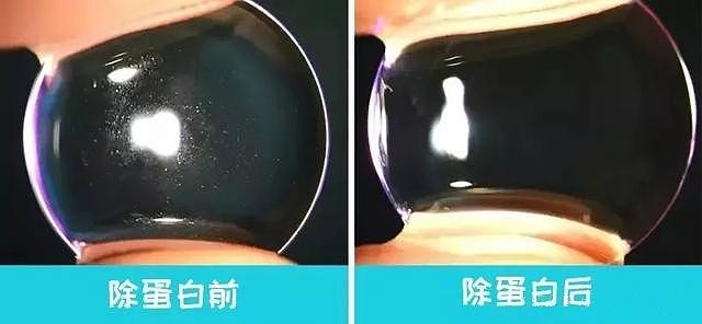 角膜塑形镜每天都清洗不用除蛋白快看看孩子角膜还好吗