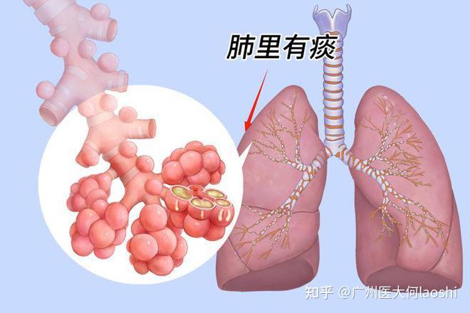 中医：“百病皆由痰作祟”，不少结节、囊肿都因“痰”而起！ - 知乎