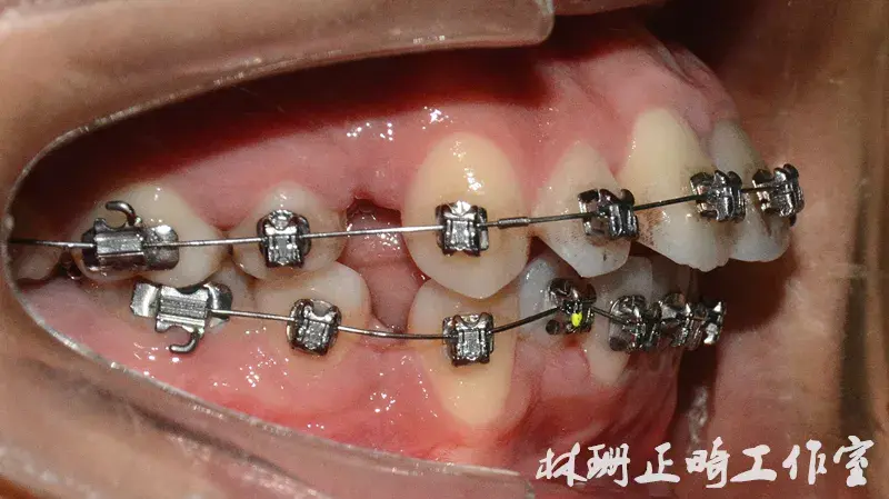 福州牙齒矯正案例前突齙牙患者害怕骨釘改用z鉤依舊獲得非常好的內收