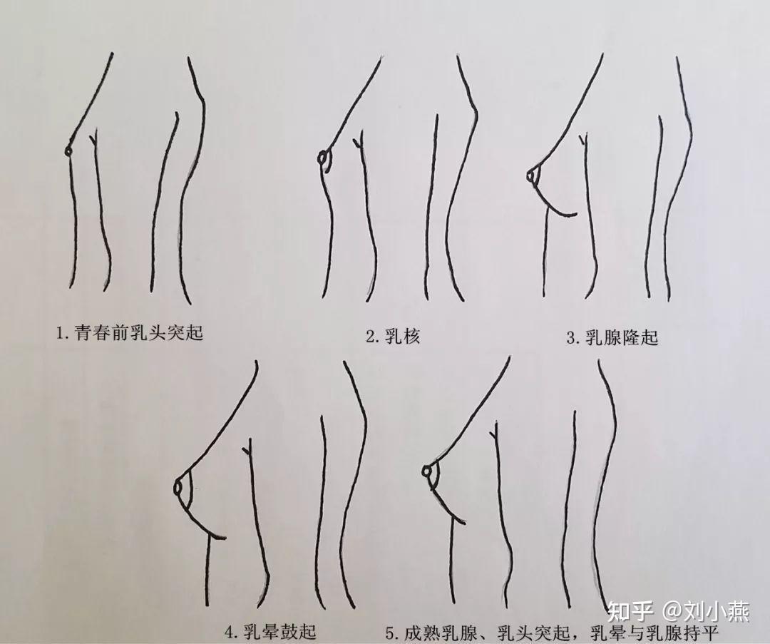 刘燕酿制:女性乳房发育什么症状